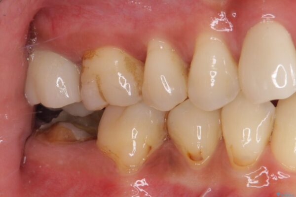 もげてしまった奥歯　部分矯正で清掃性の良い補綴治療 治療前画像