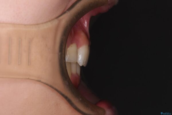 気になる八重歯を改善　補助装置併用のインビザライン治療 治療後画像