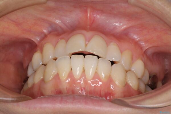気になる前歯をインビザライン・ライトで　矯正治療後には銀歯をセラミックに ビフォー