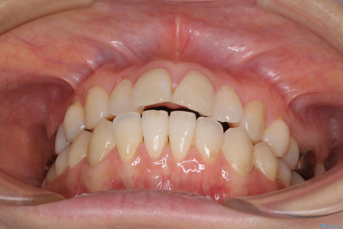 気になる前歯をインビザライン・ライトで　矯正治療後には銀歯をセラミックに 治療前
