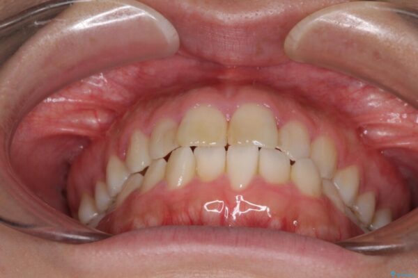 気になる前歯を治したい　インビザラインで気づかれずに矯正治療 治療前画像
