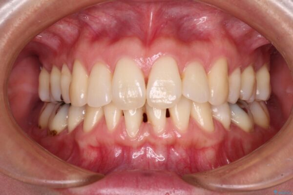 下顎前歯の歯肉退縮　歯肉移植による根面被覆 治療前画像