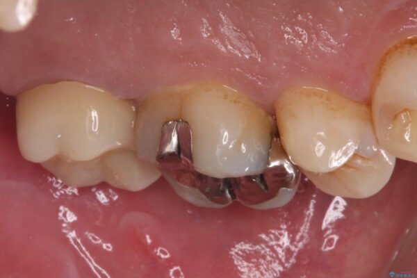 歯に穴が空いてしみる　ものが挟まってしまうほど大きな奥歯のむし歯 治療後画像