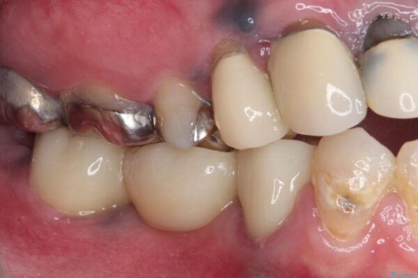 痛む奥歯　目立つ銀色の奥歯をセラミックに　セラミックブリッジ 治療後画像