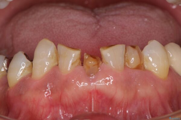 乳歯や矮小歯の多い前歯　部分矯正と補綴治療による審美歯科治療 治療前画像