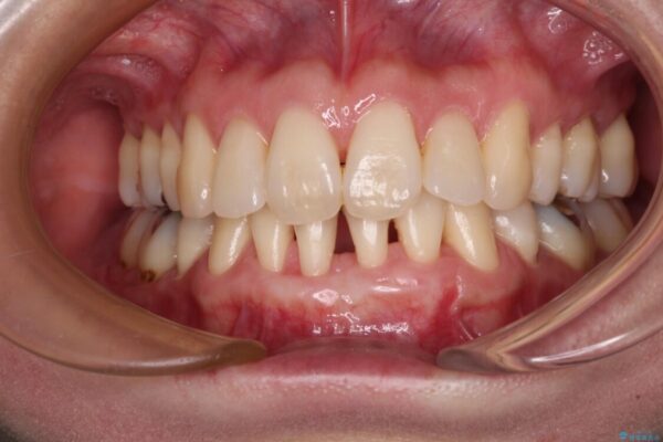 下顎前歯の歯肉退縮　歯肉移植による根面被覆 治療後画像