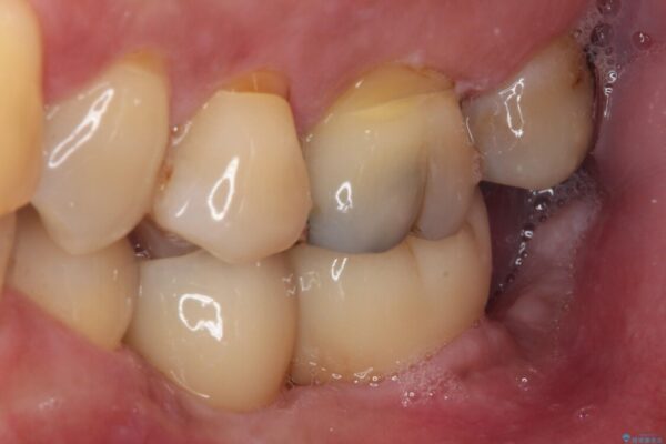 歯に穴が空いてしみる　ものが挟まってしまうほど大きな奥歯のむし歯 治療前画像