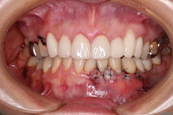 歯磨きの度にしみる歯　露出した歯根を歯肉移植で改善 治療途中画像