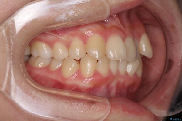 八重歯の抜歯矯正　補助装置を用いたインビザライン矯正 治療前画像