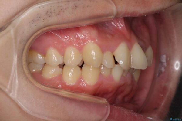 強い咬み込みですり減った前歯　デコボコを抜歯矯正で整える 治療前画像