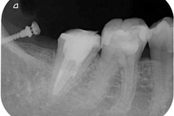 もげてしまった奥歯　部分矯正で清掃性の良い補綴治療 治療途中画像