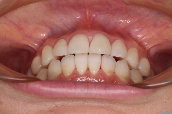 気になる前歯をインビザライン・ライトで　矯正治療後には銀歯をセラミックに アフター