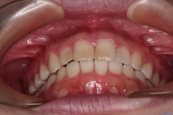 気になる前歯を治したい　インビザラインで気づかれずに矯正治療 治療後画像