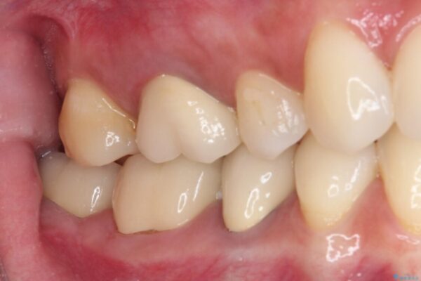 奥歯がしみる　色々な国で治療を受けてきた奥歯のむし歯治療 治療後画像