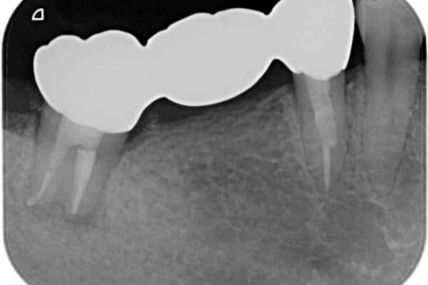 痛む奥歯　目立つ銀色の奥歯をセラミックに　セラミックブリッジ 治療後画像