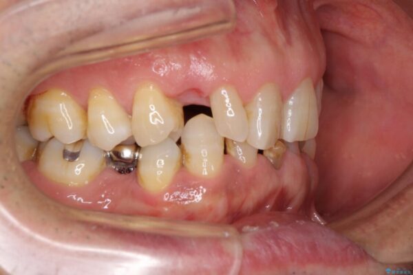 乳歯や矮小歯の多い前歯　部分矯正と補綴治療による審美歯科治療 治療前画像
