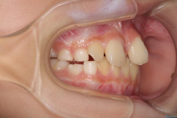 過剰歯を抜歯して前歯を排列　インビザライン・ファーストによる小学生のⅠ期治療 治療前画像