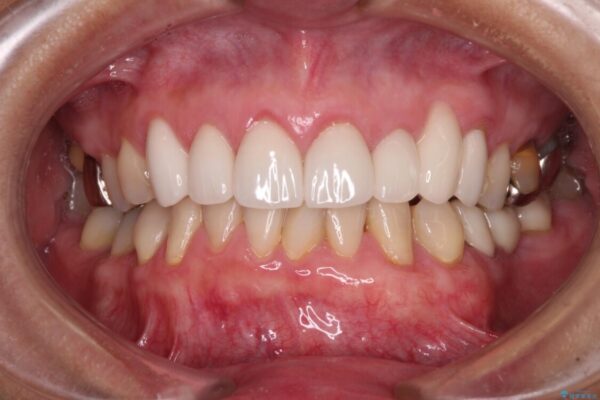歯磨きの度にしみる歯　露出した歯根を歯肉移植で改善 治療後画像