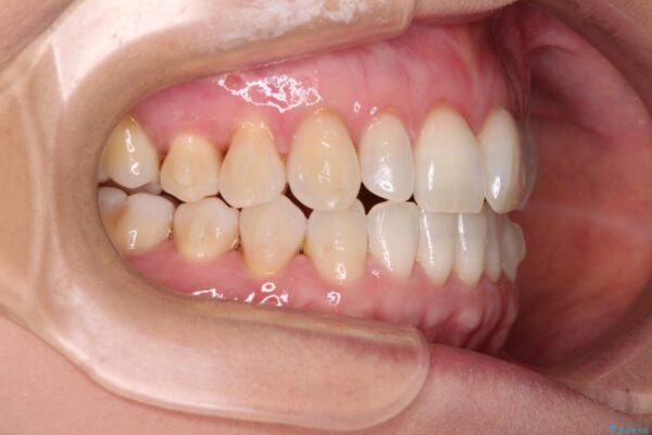 前歯のスペースが気になる　インビザラインによる矯正治療 治療途中画像