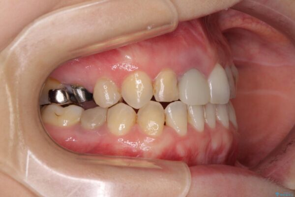 前歯のクロスバイトと治療が必要なむし歯　矯正とセラミックの総合歯科治療 治療途中画像