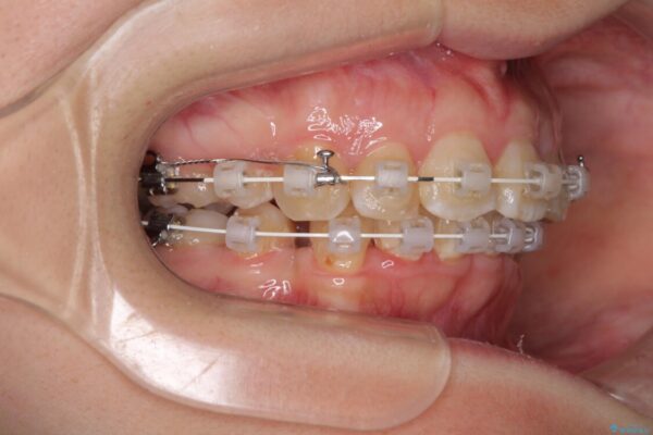飛び出した前歯を引っ込めたい　目立たないワイヤーでの抜歯矯正 治療途中画像