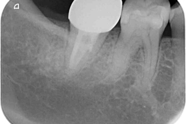 もげてしまった奥歯　部分矯正で清掃性の良い補綴治療 治療後画像