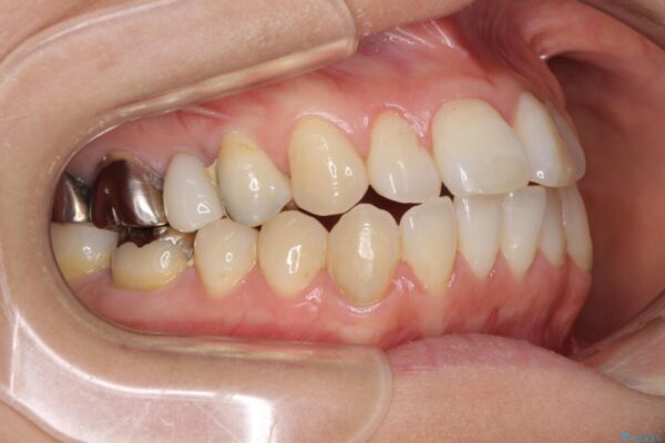 気になる前歯をインビザライン・ライトで　矯正治療後には銀歯をセラミックに 治療前画像