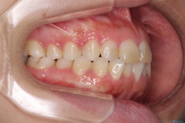 気になる前歯を治したい　インビザラインで気づかれずに矯正治療 治療前画像