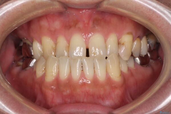前歯の反対咬合をワイヤー矯正で改善して噛みやすく ビフォー