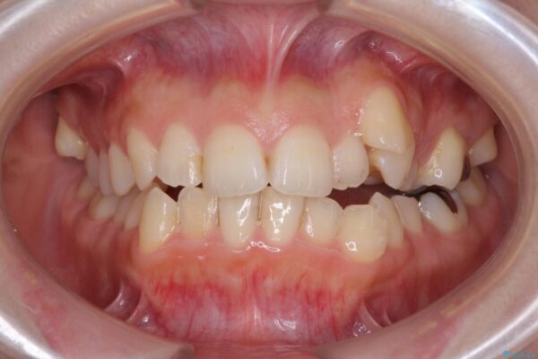 顕著な八重歯をインビザラインで治せるところまで改善 ビフォー