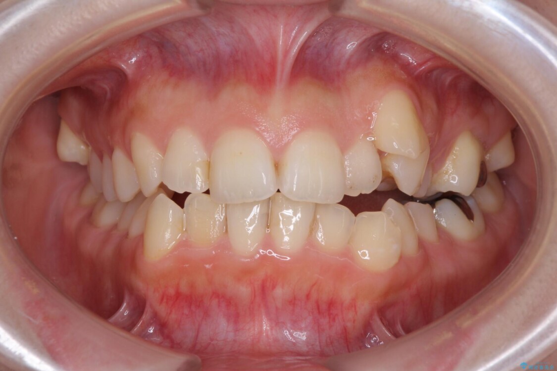 顕著な八重歯をインビザラインで治せるところまで改善 治療前