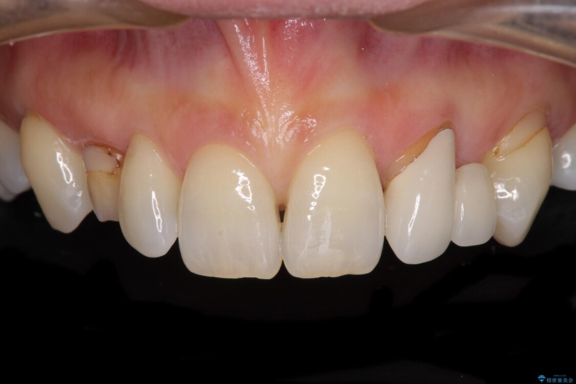 欠損の多い歯列　部分矯正とセラミックブリッジで自然な見た目に 治療前