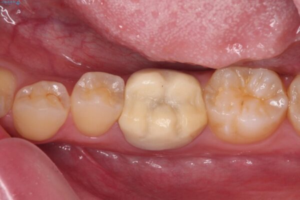 奥歯の被せものが汚れやすい　仮歯のままの歯をセラミッククラウンに ビフォー