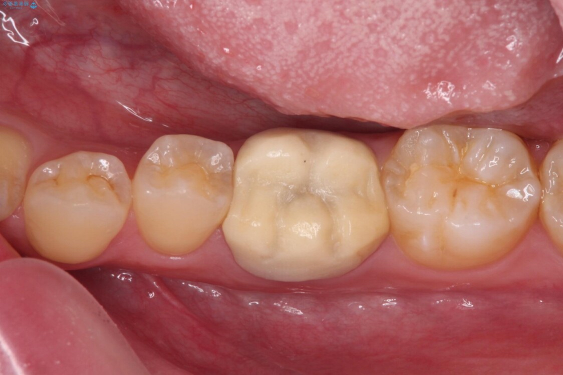 奥歯の被せものが汚れやすい　仮歯のままの歯をセラミッククラウンに 治療前