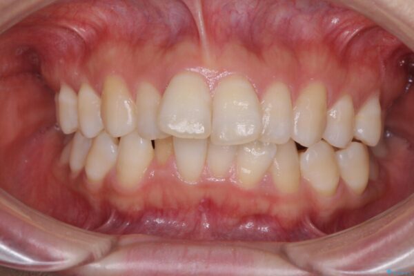 インビザラインが続けられない　ワイヤー装置による抜歯矯正 治療前画像