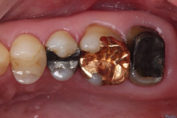 奥歯が外れた　ゴールドクラウンによる補綴治療 ビフォー