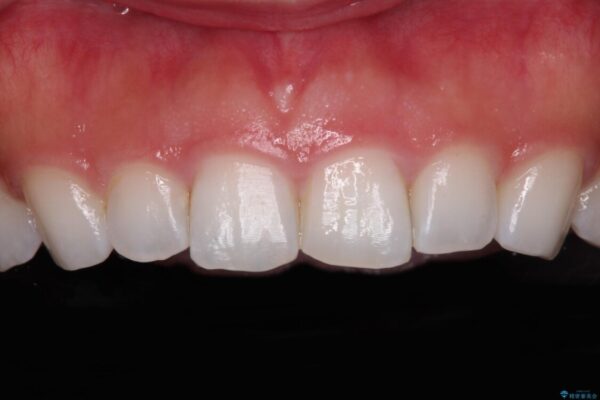 前歯の形を変えたい　前歯のラミネートベニア治療 ビフォー