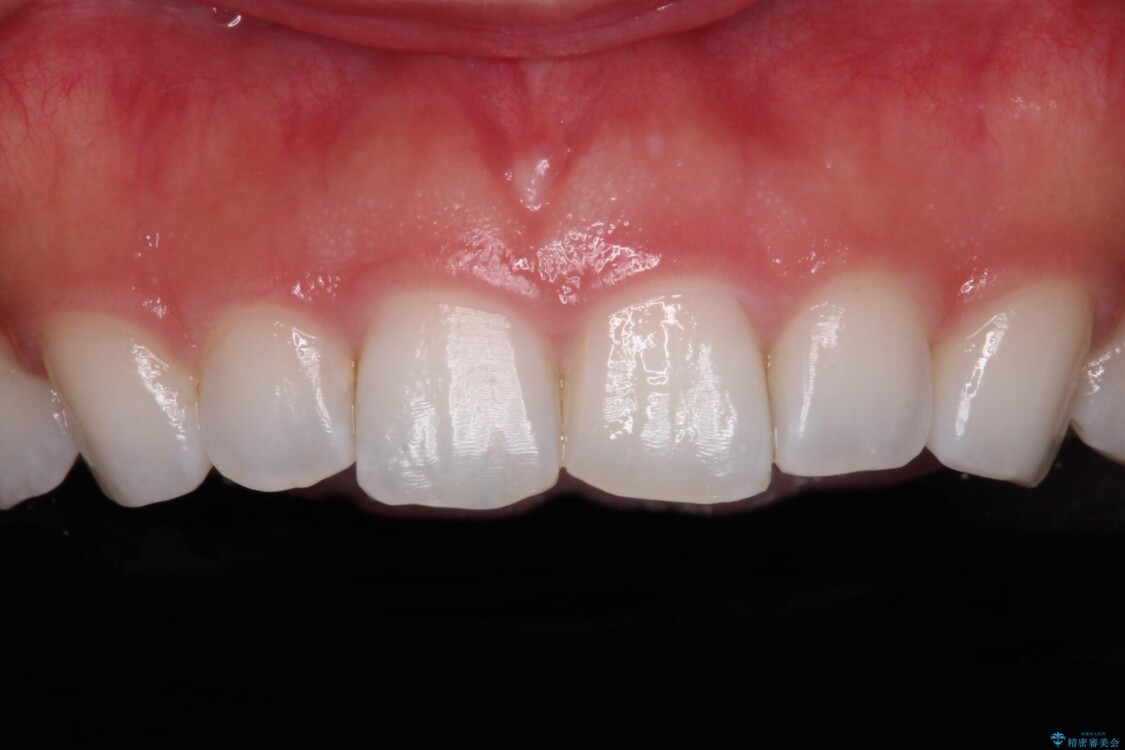 前歯の形を変えたい　前歯のラミネートベニア治療 治療前