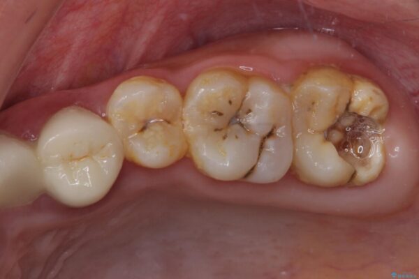 むし歯だらけの奥歯　セラミッククラウンによるむし歯治療 治療前画像