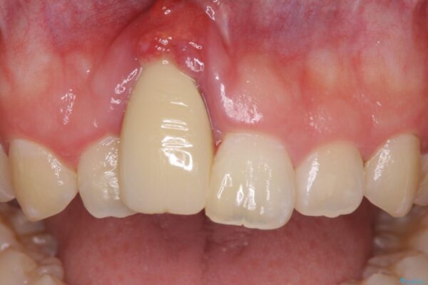 怪我をして不格好な前歯　矯正治療とインプラント補綴治療 ビフォー