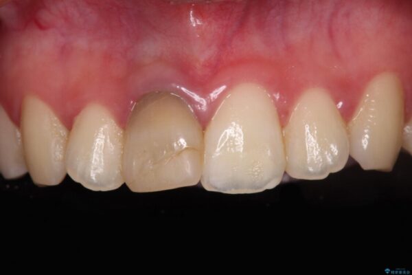茶色になった前歯　オーダーメイドタイプのオールセラミッククラウン 治療前画像