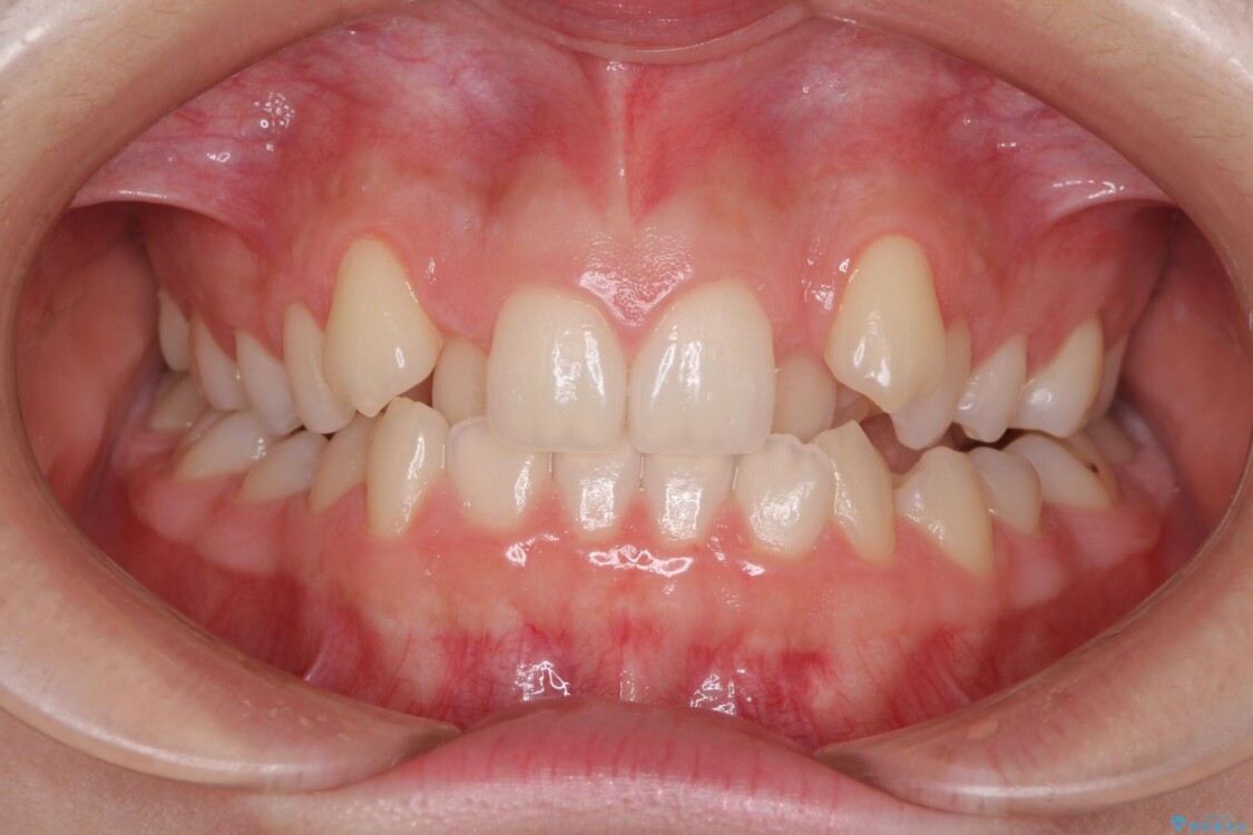目立つ八重歯を目立たない装置で　ハーフリンガルによる抜歯矯正 治療前