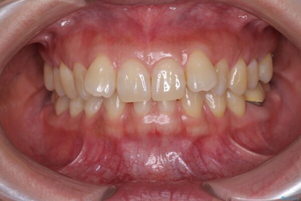 下顎2前歯の欠損　インビザラインによる抜歯矯正 ビフォー