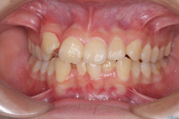 八重歯で正中が右にずれている　ワイヤー装置での抜歯矯正で正中位置を改善 ビフォー