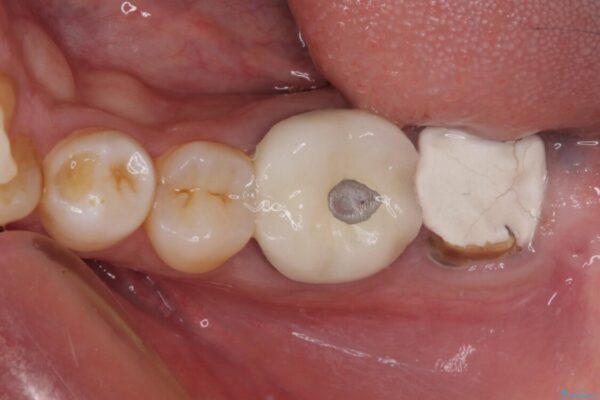 抜歯が必要な奥歯　ストローマン・インプラント補綴治療 ビフォー