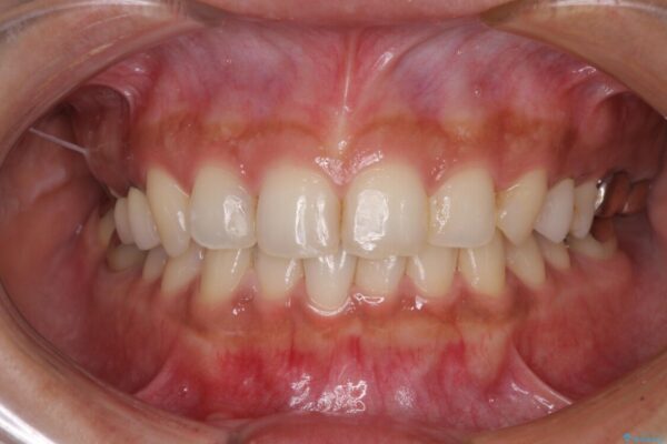 むし歯だらけの歯を治したい　インプラントを用いた補綴治療 治療前画像