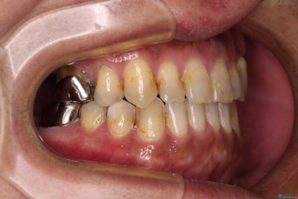 前歯の反対咬合をワイヤー矯正で改善して噛みやすく 治療後画像