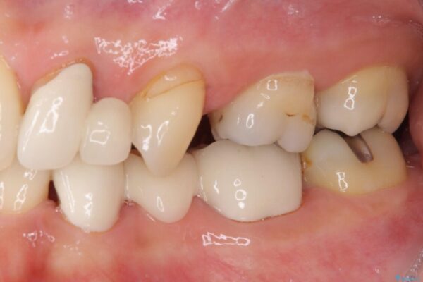 欠損の多い歯列　部分矯正とセラミックブリッジで自然な見た目に 治療前画像