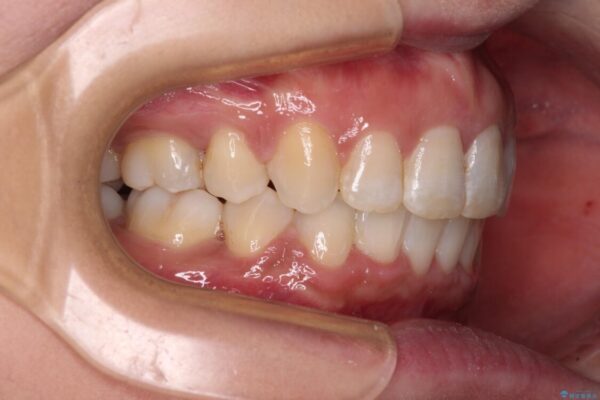 インビザラインが続けられない　ワイヤー装置による抜歯矯正 治療後画像