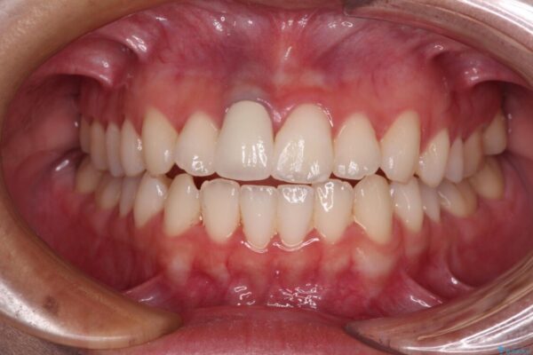 茶色になった前歯　オーダーメイドタイプのオールセラミッククラウン 治療後画像
